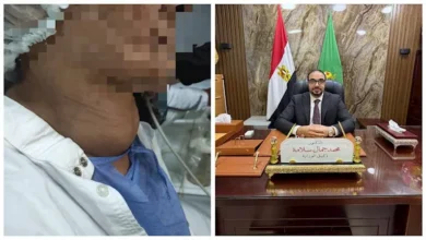 فريق طبي ينجح في استئصال ورم ضخم بالغدة الدرقية لسيدة في الفيوم