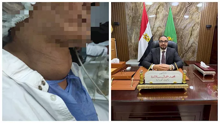 فريق طبي ينجح في استئصال ورم ضخم بالغدة الدرقية لسيدة في الفيوم