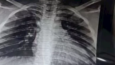 "دبوس طرحة" كاد يقتلها.. 3 أطباء ينقذون طفلة من الموت في كفر الشيخ - ف