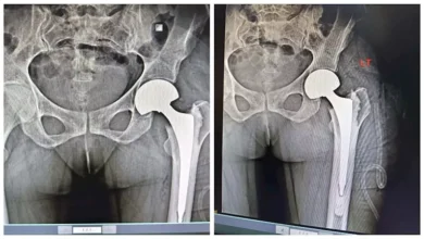 نجاح أول جراحة لاستبدال مفصل الفخذ بمستشفى الفكرية المركزي