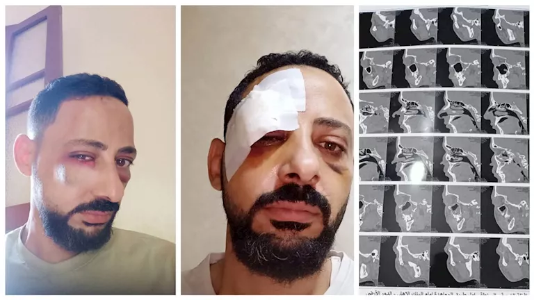 استغاثة مواطن بالغربية بعد إصابته بكسور: "ركبت شرايح ومسامير"